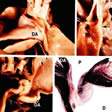 Coartación de la aorta