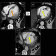 Comunicación interventricular