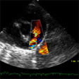 Conducto arterioso permeable