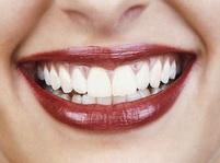 Blanquear los Dientes: Hacerlo de la Manera Profesional