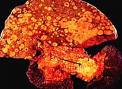 Cancer de pancreas