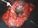 Carcinomas hepáticos