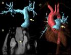 Estenosis aortica