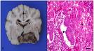 GCT extragonadales y carcinoma de la línea media de histogénesis dudosa
